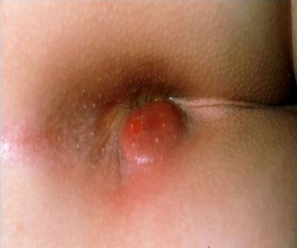 fissures